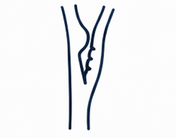 Estenose carotídea